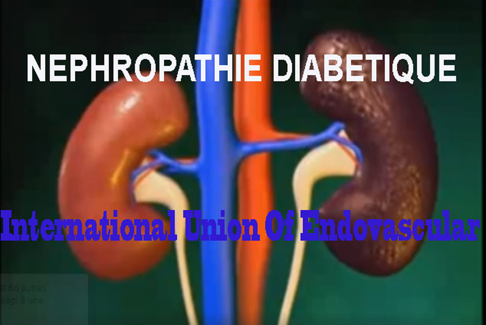 Néphropathie diabétique et Hypertension arterielle chez les diabétiques