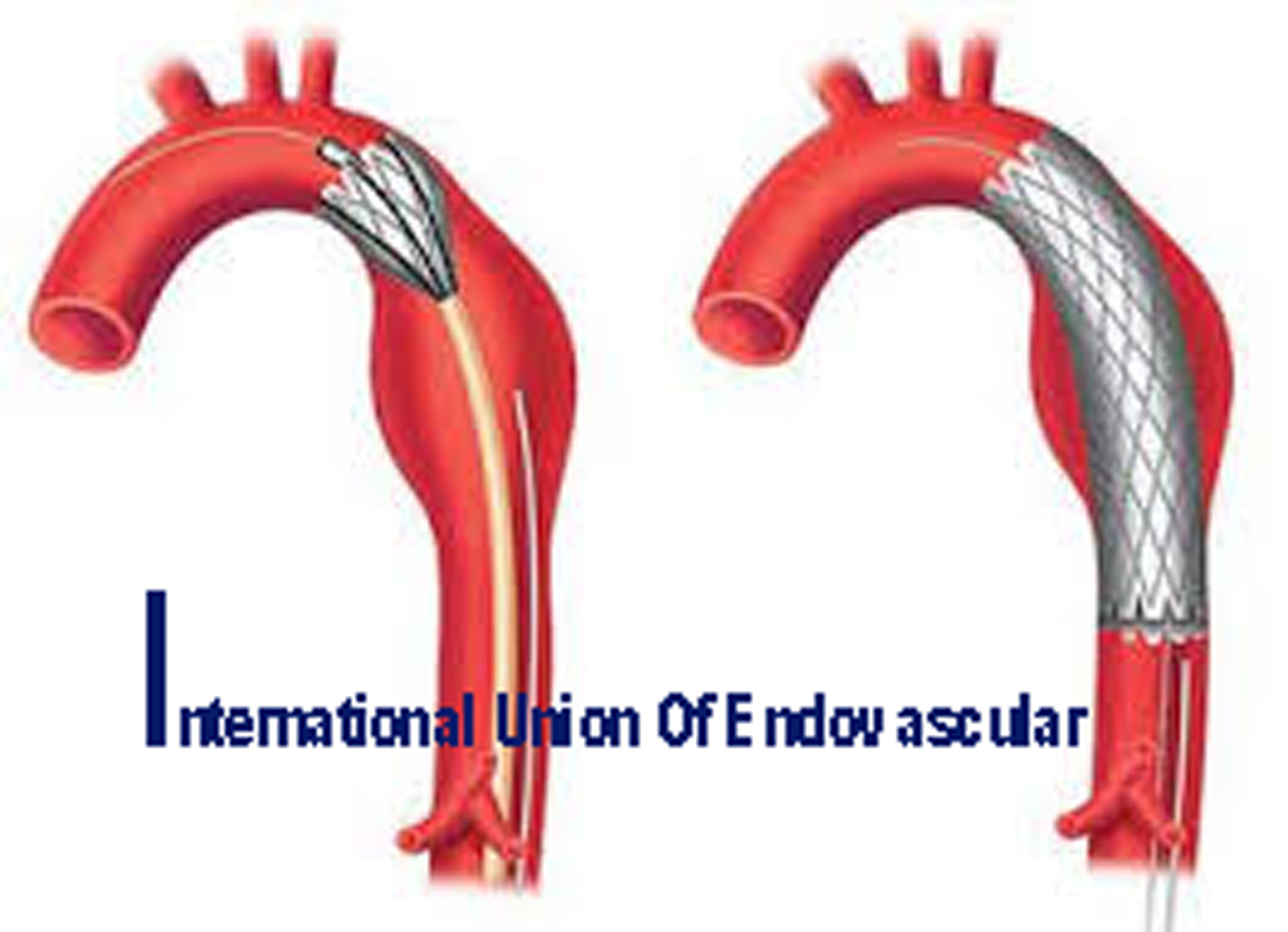 International Union Of Endovascular