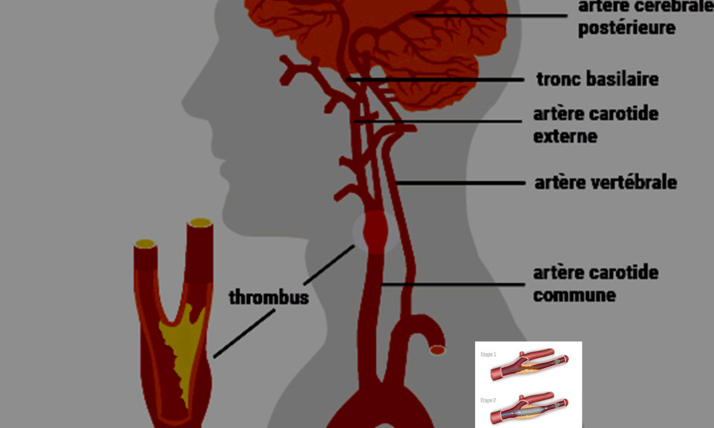 ACCIDENT VASCULAIRE CÉRÉBRAL ISCHÉMIQUE – International Union Of ...