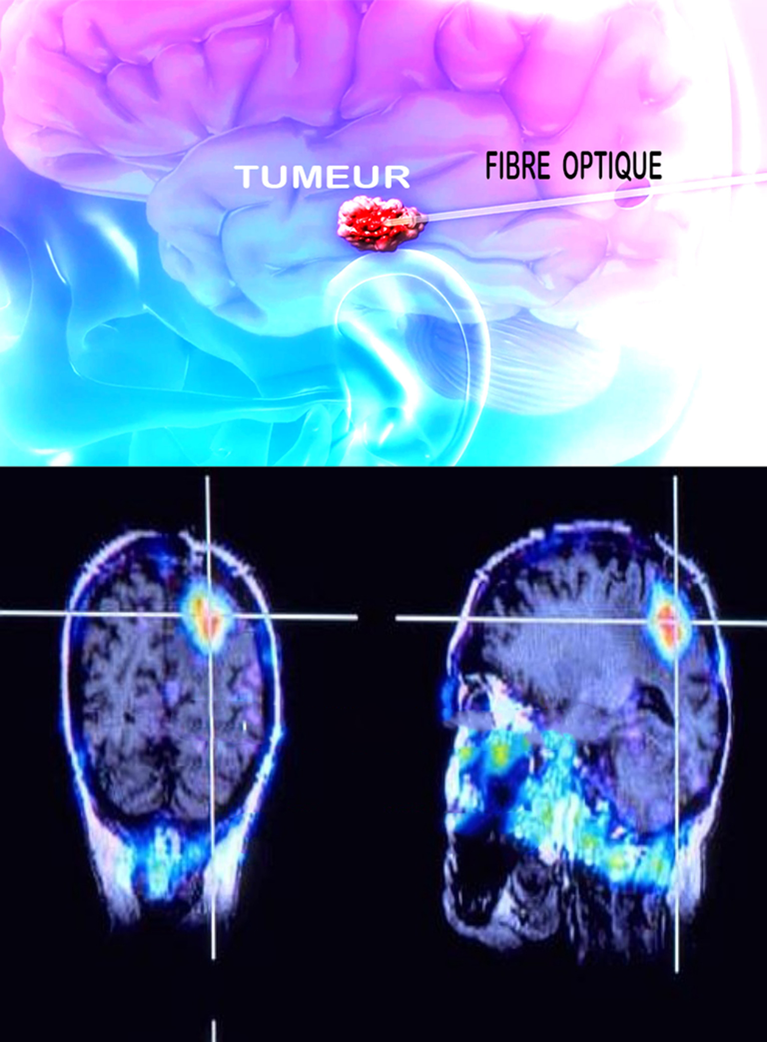 Traitement lasers dans les tumeurs cerebrales - International ...