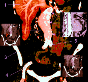 La complication la plus redoutable de l'anévrisme de l'aorte abdominale (AAA) est la rupture, qui entraînera des taux de mortalités atteignant le 50%. 