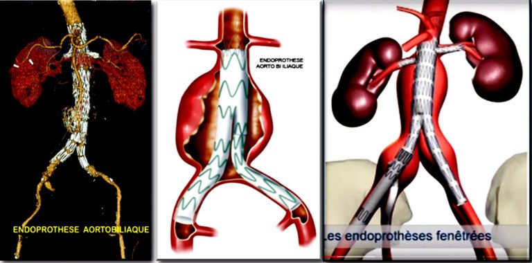 Anévrisme De L Aorte Esperance De Vie