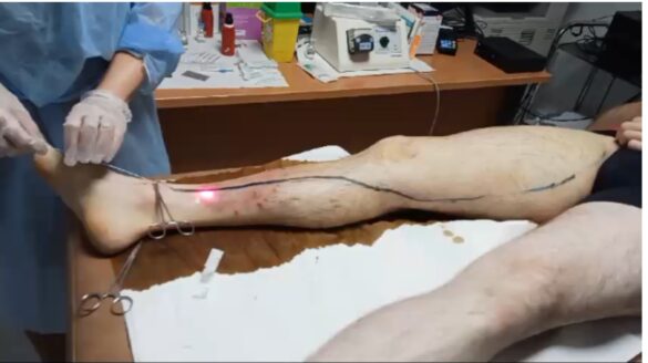Centre Traitement Varices le BOULOU (traitement micro-invasif des varices: Laser endoveineux, en occitanie Perpignan le BOULOU