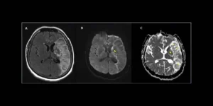 COVID 19 Le SARS-CoV-2, nom du coronavirus responsable de la Covid-19, pourrait-il envahir le système nerveux ? C’est la question que nous nous posions en avril 2020. A l’époque, malgré un faisceau d’indices convergents, il n’était pas possible de conclure. Depuis, plusieurs études sont venues apporter des éléments de réponse. Ainsi, on a retrouvé des traces d’ARN du virus dans le cerveau de patients décédés de la Covid-19 ainsi que des protéines virales dans des cellules de leur bulbe olfactif. Récemment, des équipes de l’Université de Yale, aux États-Unis, de l’Institut du Cerveau et de l’hôpital Pitié-Salpêtrière, en France, ont publié une découverte importante : elles ont montré que le SARS-CoV-2 pouvait infecter diverses cellules du système nerveux central, dont les neurones, chez des souris exprimant le récepteur humain ACE2. Les chercheurs ont également identifié les conséquences de cette infection sur les tissus cérébraux atteints…