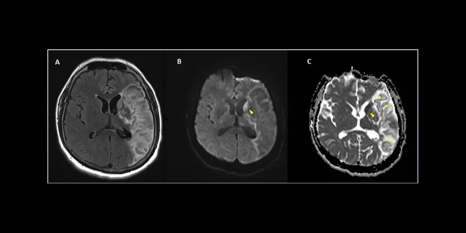 Le SARS-CoV-2, nom du coronavirus responsable de la Covid-19, pourrait-il envahir le système nerveux ? C’est la question que nous nous posions en avril 2020. A l’époque, malgré un faisceau d’indices convergents, il n’était pas possible de conclure. Depuis, plusieurs études sont venues apporter des éléments de réponse. Ainsi, on a retrouvé des traces d’ARN du virus dans le cerveau de patients décédés de la Covid-19 ainsi que des protéines virales dans des cellules de leur bulbe olfactif. Récemment, des équipes de l’Université de Yale, aux États-Unis, de l’Institut du Cerveau et de l’hôpital Pitié-Salpêtrière, en France, ont publié une découverte importante : elles ont montré que le SARS-CoV-2 pouvait infecter diverses cellules du système nerveux central, dont les neurones, chez des souris exprimant le récepteur humain ACE2. Les chercheurs ont également identifié les conséquences de cette infection sur les tissus cérébraux atteints…