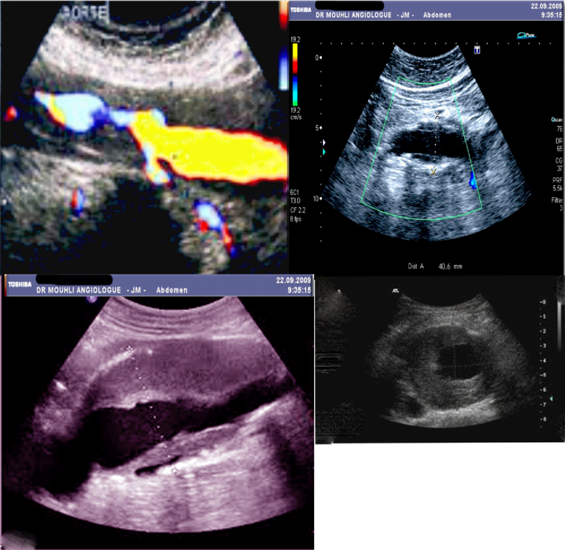 les-an-vrismes-de-l-aorte-abdominale-international-union-of-endovascular