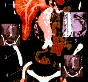 La complication la plus redoutable de l'anévrisme de l'aorte abdominale (AAA) est la rupture, qui entraînera des taux de mortalités atteignant le 50%. La complication la plus redoutable de l'anévrisme de l'aorte abdominale (AAA) est la rupture, qui entraînera des taux de mortalités atteignant le 50%.