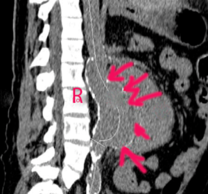 La complication la plus redoutable de l'anévrisme de l'aorte abdominale (AAA) est la rupture, qui entraînera des taux de mortalités atteignant le 50%. La complication la plus redoutable de l'anévrisme de l'aorte abdominale (AAA) est la rupture, qui entraînera des taux de mortalités atteignant le 50%.