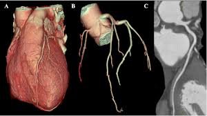 CORONOSCANNER Le coroscanner (ou scanner cardiaque) permet de réaliser des images en coupes très fines du muscle cardiaque et de ses vaisseaux (notamment les artères coronaires). Les images sont très précises. Elles peuvent montrer des détails de l'ordre du millimètre.