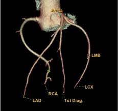 Le coroscanner (ou scanner cardiaque) permet de réaliser des images en coupes très fines du muscle cardiaque et de ses vaisseaux (notamment les artères coronaires). Les images sont très précises. Elles peuvent montrer des détails de l'ordre du millimètre.