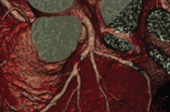 Le coroscanner (ou scanner cardiaque) permet de réaliser des images en coupes très fines du muscle cardiaque et de ses vaisseaux (notamment les artères coronaires). Les images sont très précises. Elles peuvent montrer des détails de l'ordre du millimètre.